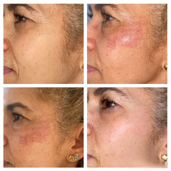 Rejuvenecimiento facial láser CO2