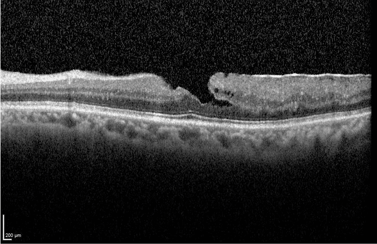 Agujero macular lamelar fondo de ojo